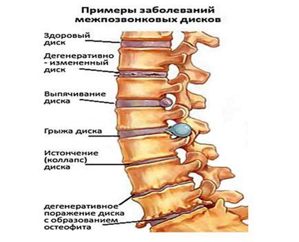 спондилартроза на гръден гръбначен стълб етап 1